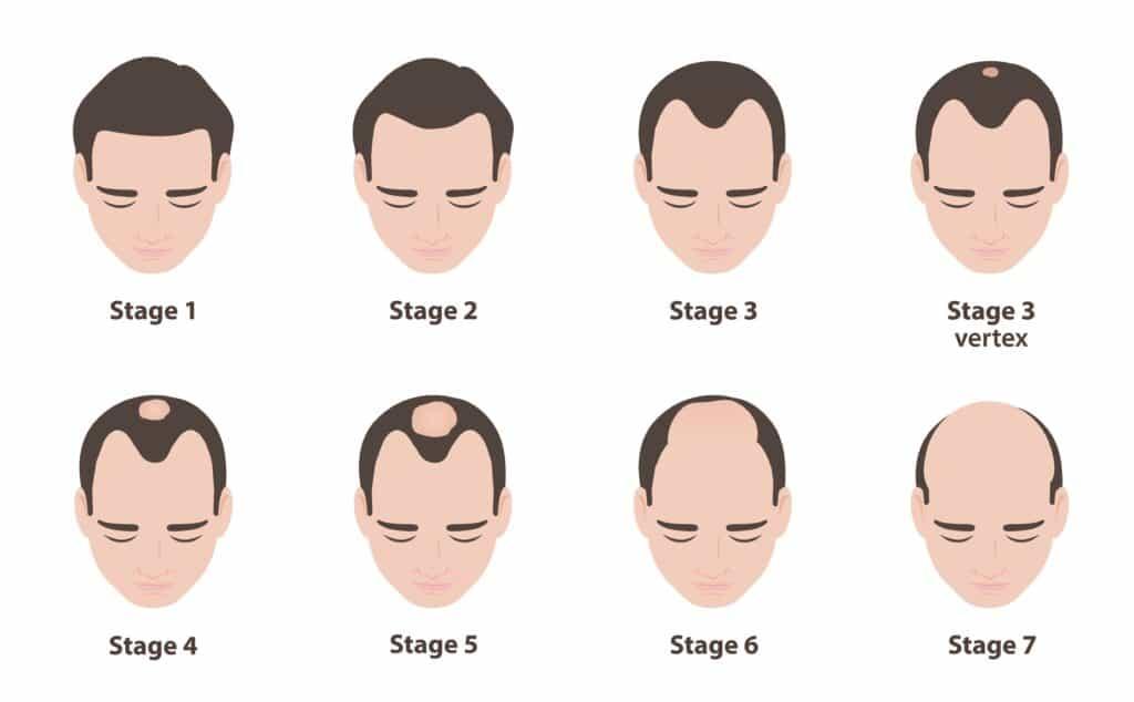 Hair Loss and Baldness